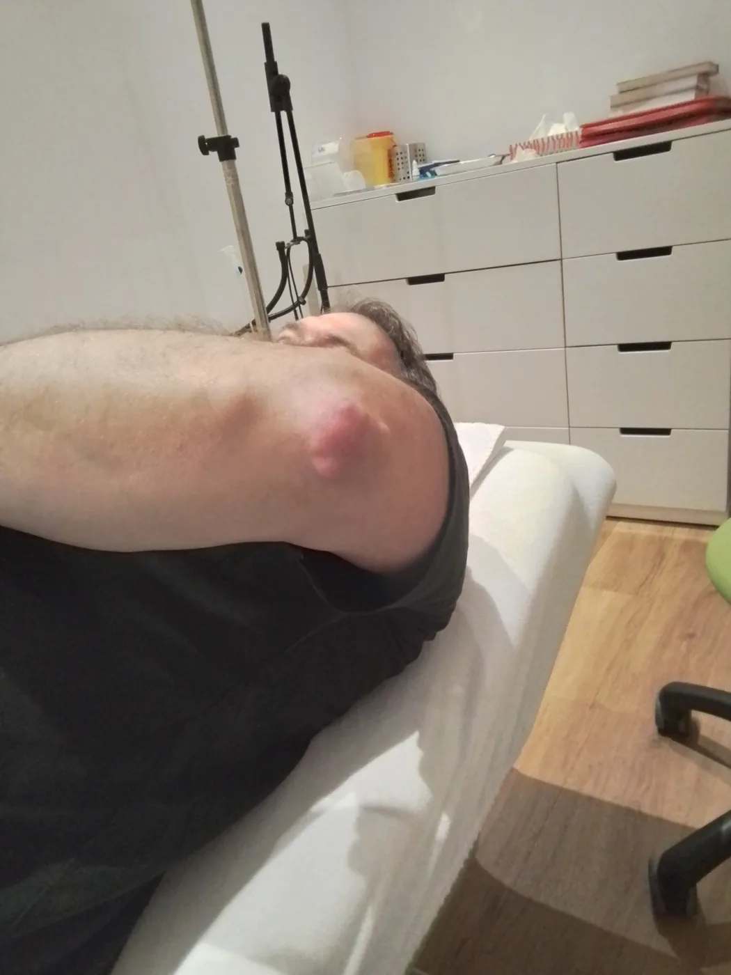 Nahaufnahme eines Ellbogens mit sichtbarer Schwellung des Gelenks