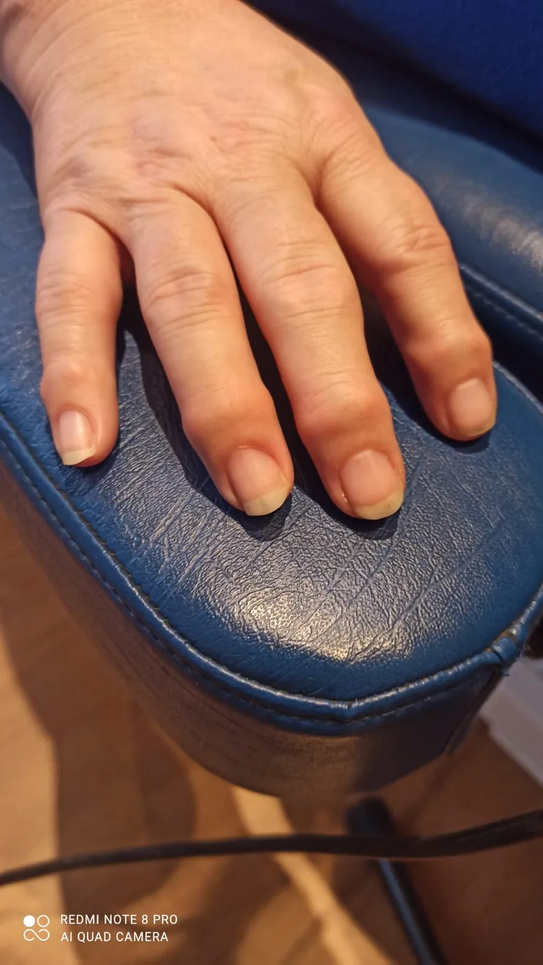 Nahaufnahme einer Hand mit verdickten Fingerendgelenken, wie sie bei Heberdenarthrose auftreten